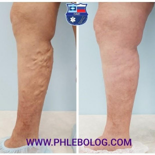 Лечение варикоза радиочастотой без следа