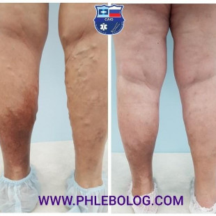 Варикоз и венозная экзема - лечение  методом РЧА