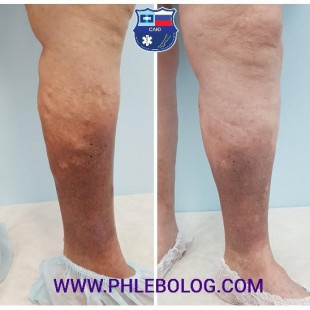 Трофическая экзема левой голени