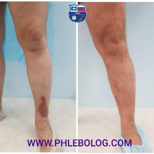 Трофическая экзема - лечение лазером без операции