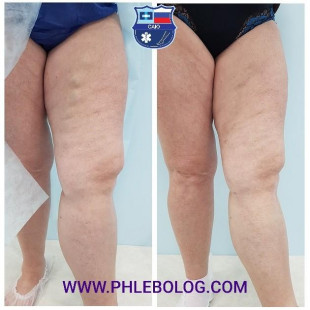 Переднелатеральный приток на бедре - удален лазером