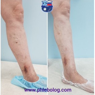 Трофическая венозная экзема после лечения лазером