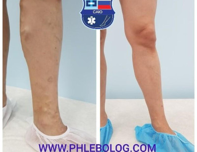 Склеротерапия варикозных вен на левой голени