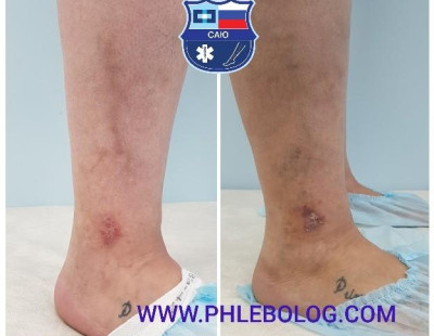 Трофической венозная экзема - лечение лазером