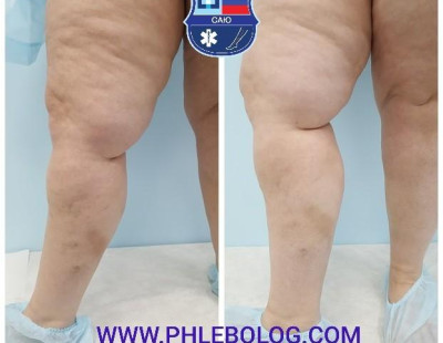 Тромбофлебит в бассейне БПВ справа - лечение лазером