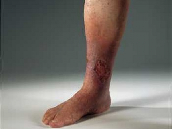 Трофическая язва. Лечение и причины венозных трофических язв на ногах.