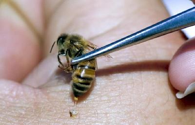 Апитерапия - лечение варикоза с помощью пчел