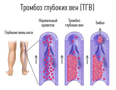 Механизм развития тромбоза глубоких вен